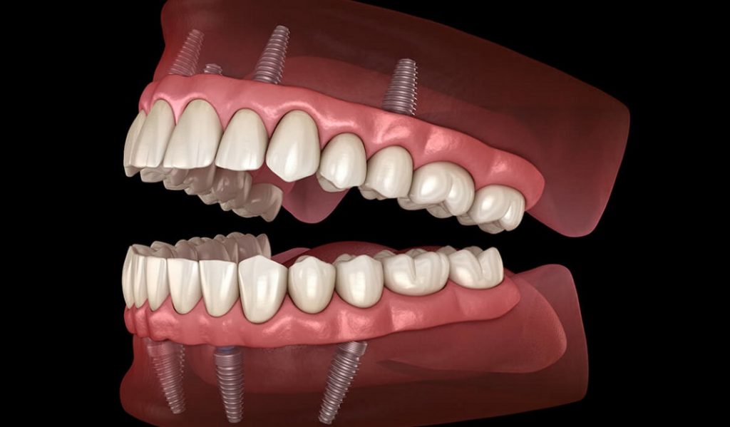 how-to-maximize-the-lifespan-of-implant-supported-dentures