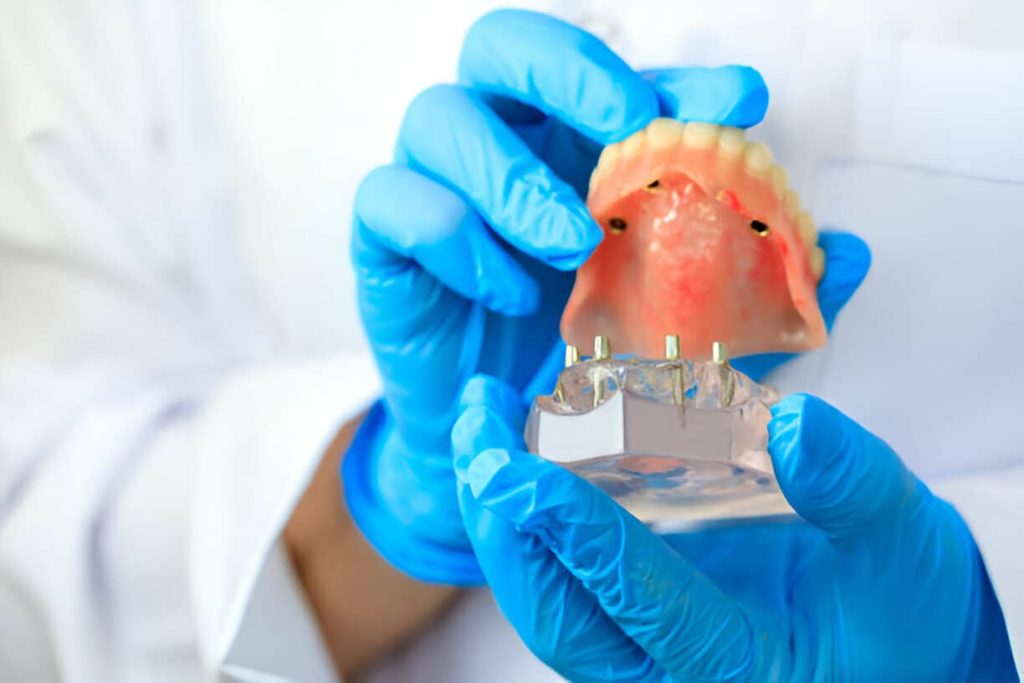 Are Implant-Supported Dentures Worth It?