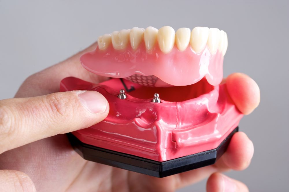 dentist fitting implant-supported dentures